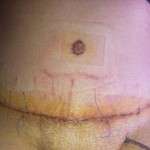 Tummy tuck scars photos (5)