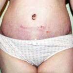 Tummy tuck scars pictures