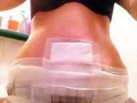 Tummy tuck surgery aftercare