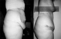 Tummy tuck wiki before and after