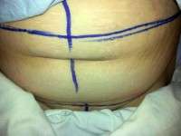 Weight gain after abdominoplasty