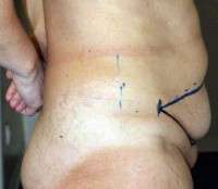 Weight gain after tummy tuck surgery