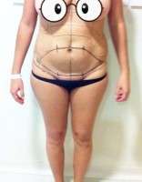 Weight gaining abdominoplasty