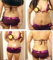 What is a tummy tuck surgery do