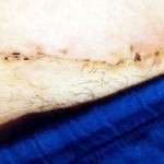 pictures of abdominoplasty scars (1)