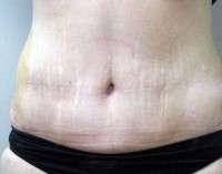 3 weeks post op tummy tuck swelling image