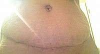 3 weeks post op tummy tuck swelling images