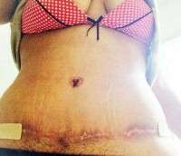 6 weeks post op tummy tuck surgery swelling
