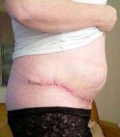 A scars from tummy tuck