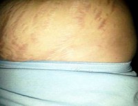A stretch marks after tummy tuck