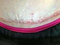 A tummy tuck scar post op swelling