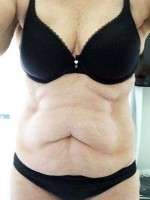 A tummy tuck surgery candidate
