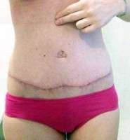 A tummy tuck surgery post op swelling