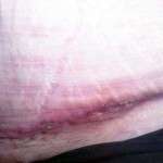 A tummy tuck swelling photos