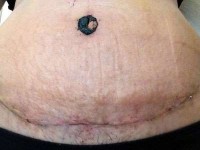 A tummy tuck without drains