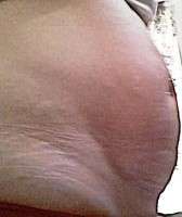 Abdominoplasty after pregnancy photo