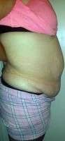 Abdominoplasty post pregnancy