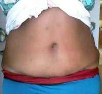 Abdominoplasty scar photos