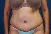 Abdominoplasty scarring pictures