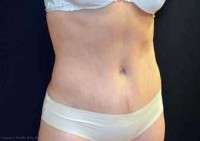 Abdominoplasty scars picture
