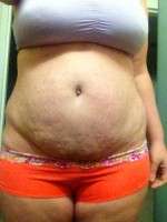 Abdominoplasty surgery after pregnancy