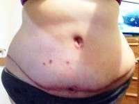 Abdominoplasty swelling after 4 weeks