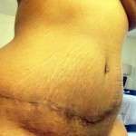 Abdominoplasty swelling scar picture