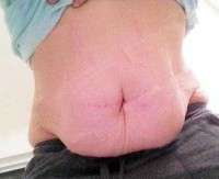 Abdominoplasty then pregnancy