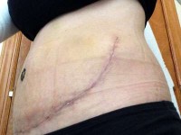 Abdominoplasty without drains