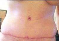 After 6 weeks post op tummy tuck surgery swelling