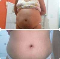 After pregnancy tummy tuck before