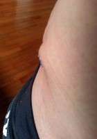 After pregnancy tummy tuck remove strech marks