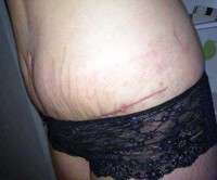 After tummy tuck for weight loss