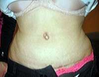 Amazing tummy tuck results scar