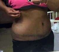 An abdominoplasty scarring