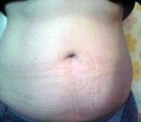 An abdominoplasty surgery cost