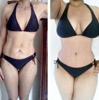 Before and after tummy tuck alternative laser