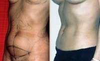 C section and tummy tuck before and after
