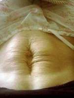 C section and tummy tuck operation