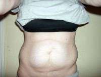 C section and tummy tuck photo