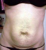 C section and tummy tuck surgery