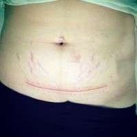 C section tummy tuck surgery