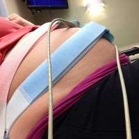 Can i have a baby after a tummy tuck photo