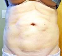 Difference between mini tummy tuck and full tummy tuck surgery