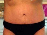 Does a tummy tuck remove stretch marks image