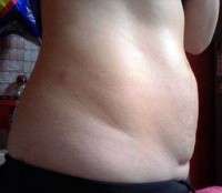 Does a tummy tuck remove stretch marks photo
