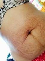 Does abdominoplasty remove stretch marks