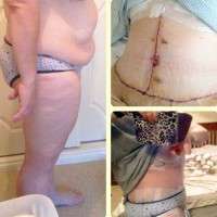 Fleur de lis tummy tuck before and after