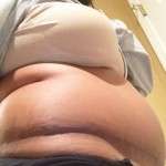 Gaining weight after a tummy tuck
