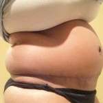 Gaining weight after the tummy tuck